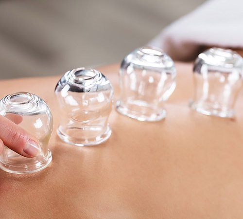 Cupping and Dry Needling